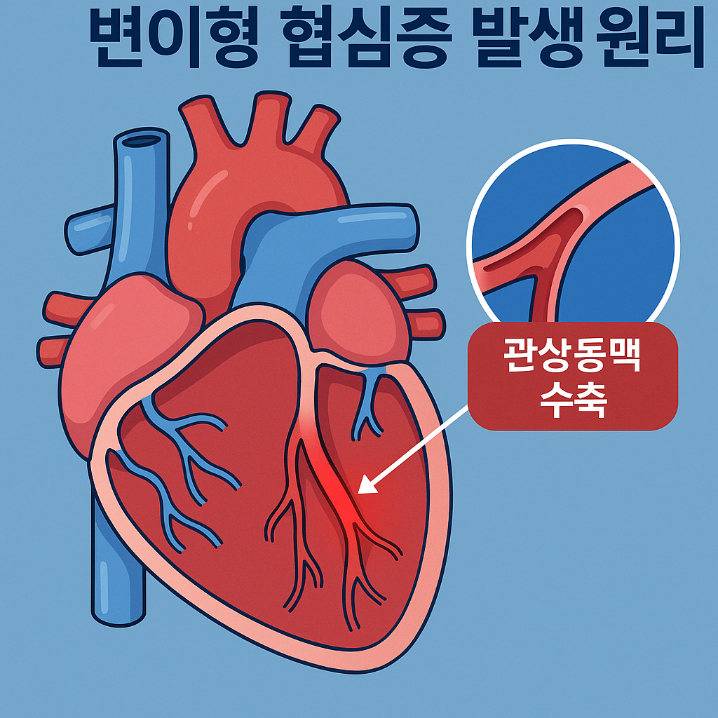 변이형 협심증 발생 원리 일러스트
